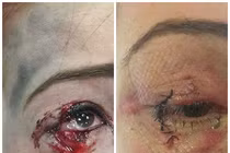 Kinh hoàng những vụ tai nạn nổ thuốc lá điện tử