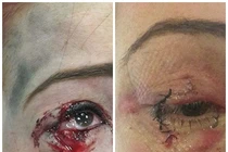 Kinh hoàng những vụ tai nạn nổ thuốc lá điện tử