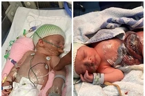 Xót lòng em bé sinh ra với bộ ruột ngoài cơ thể
