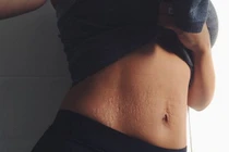 Ảnh rạn da của bà mẹ bỉm sữa gây sốt mạng