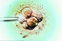 Đứa trẻ đầu tiên mang gene 3 bố mẹ sắp chào đời