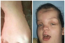 Cuộc sống khó khăn của cô gái bị hội chứng người voi