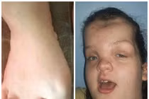 Cuộc sống khó khăn của cô gái bị hội chứng người voi