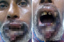 Rùng mình giòi bò lúc nhúc trong miệng người đàn ông