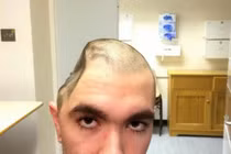 Kinh hãi đầu méo xệch vì phải bỏ một phần hộp sọ