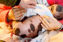 Thương tâm em bé sinh ra với vết đốm toàn cơ thể