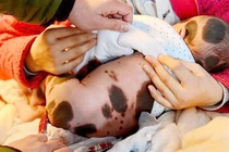 Thương tâm em bé sinh ra với vết đốm toàn cơ thể