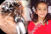 Rùng mình ổ kiến sống lâu năm trong tai bé gái