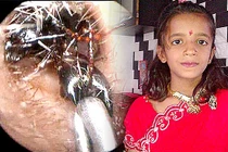 Rùng mình ổ kiến sống lâu năm trong tai bé gái