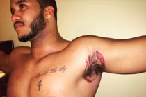 Quý ông điển trai loét nách vì lăn khử mùi