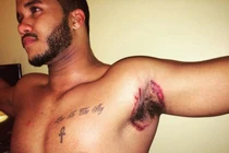 Quý ông điển trai loét nách vì lăn khử mùi