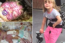 Thương tâm em bé xinh đẹp đầy vết chàm tím trên mặt