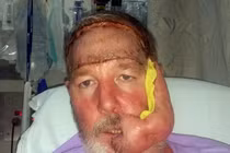 Khuôn mặt biến dạng khủng khiếp vì ung thư da