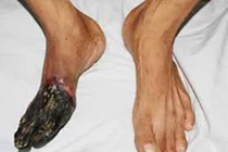 Rùng mình loạt bệnh gây hoại tử đáng sợ 