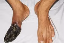 Rùng mình loạt bệnh gây hoại tử đáng sợ 