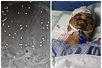 Sống sót kỳ diệu dù trúng 80 viên đạn vào đầu