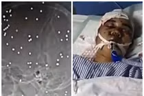 Sống sót kỳ diệu dù trúng 80 viên đạn vào đầu