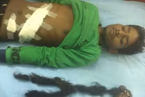 Hãi hùng nam thanh niên mang bào thai ký sinh 18 năm