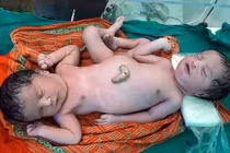 Siêu âm thai bình thường, mẹ đẻ cặp song sinh dính liền