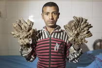 Kinh hãi người đàn ông mắc hội chứng người cây