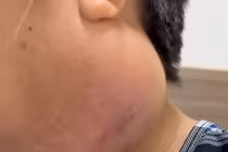 Cắt bỏ khối u khe mang gây khó chịu suốt hơn 10 năm