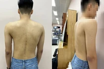 Khám sàng lọc, chẩn đoán hình ảnh miễn phí bệnh gù, vẹo cột sống trẻ em