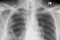 View - Tức nặng ngực không ngờ u trung thất đè ép tim, phổi | Báo Tri thức và Cuộc sống - TIN TỨC PHỔ BIẾN KIẾN THỨC 24H