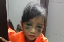 Bé lớp 1 bị cô giáo đánh tím mặt vì viết chính tả chậm?