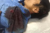 Nạn nhân kể lại giây phút kinh hoàng bị hàng chục côn đồ chém dã man