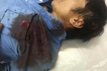 Nạn nhân kể lại giây phút kinh hoàng bị hàng chục côn đồ chém dã man