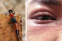 Sai lầm khiến bạn trúng độc kiến ba khoang gây nguy hiểm