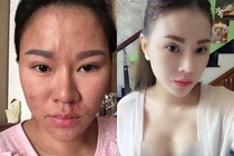 "Choáng ngất" quá trình thẩm mỹ đau đớn của bà mẹ 9x Hà Thành