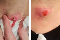 Cận cảnh màn nặn mụn to kinh hoàng ở nách