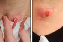 Cận cảnh màn nặn mụn to kinh hoàng ở nách