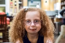 Thương tâm bé gái không thể thở vì thiếu xương hàm dưới