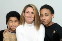 Mất nửa khuôn mặt do ung thư xoang hàm