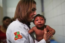 Dị tật đầu nhỏ có thể không phải do virus Zika