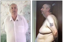 Da thừa chảy xuống tận chân sau khi giảm 70kg