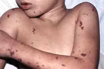 Viêm màng não mô cầu dễ nhầm với các bệnh khác