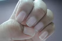 Dấu hiệu bệnh khó chữa qua màu móng tay