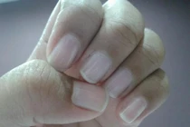 Dấu hiệu bệnh khó chữa qua màu móng tay
