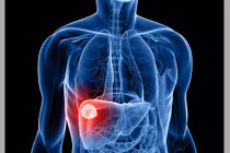 6 dấu hiệu cảnh báo ung thư gan nhiều người bỏ sót 