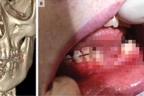 Cậu bé 17 tuổi gãy đôi xương hàm vì thuốc lá điện tử phát nổ