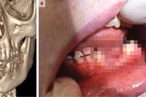 Cậu bé 17 tuổi gãy đôi xương hàm vì thuốc lá điện tử phát nổ
