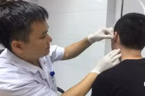 Nam sinh biến dạng “tai súp lơ” vì thích đeo khuyên cho "ngầu"