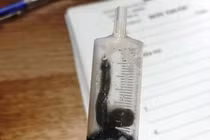 Phát hiện con vắt dài 5cm sống trong mũi người phụ nữ trong những ngày Tết