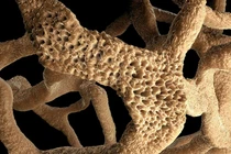 Căn bệnh hơn 3 triệu người Việt Nam mắc nhưng chỉ 20% biết bệnh