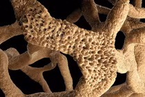 Căn bệnh hơn 3 triệu người Việt Nam mắc nhưng chỉ 20% biết bệnh