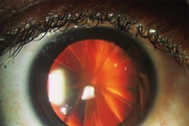 Kỳ lạ người phụ nữ có đôi mắt như chiếc bánh pizza cắt lát