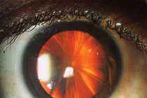 Kỳ lạ người phụ nữ có đôi mắt như chiếc bánh pizza cắt lát